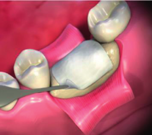 Tooth Membrane Dental Resorbable Barrier Membrane | Medosis